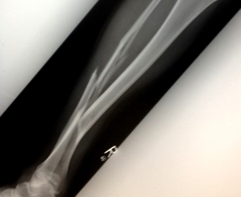 My broken fibula (you can't really see the tibia fracture from here).